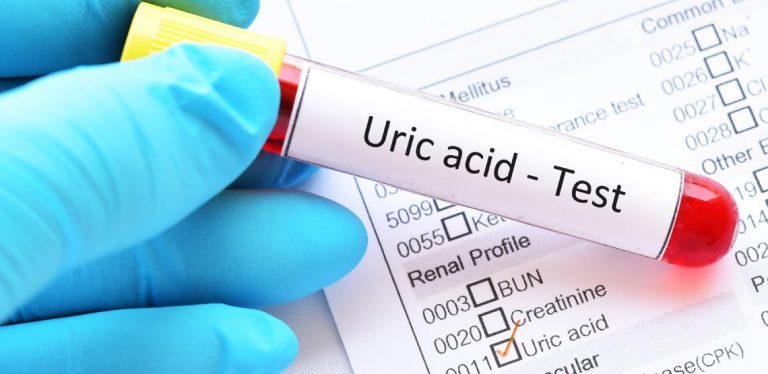 A doctor holding a sample vial that says "uric acid test"